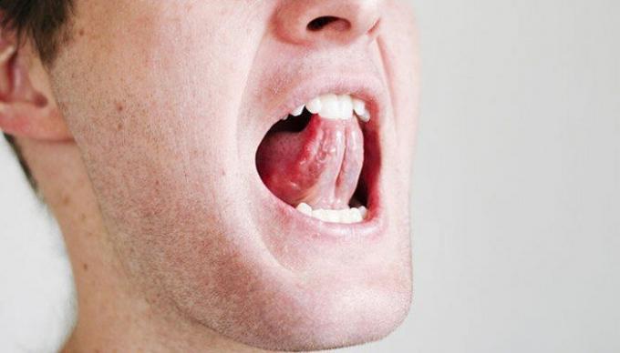 Alcuni semplici esercizi per la gola e della lingua possono alleviare la situazione con il russare. / Foto: i2.wp.com. 